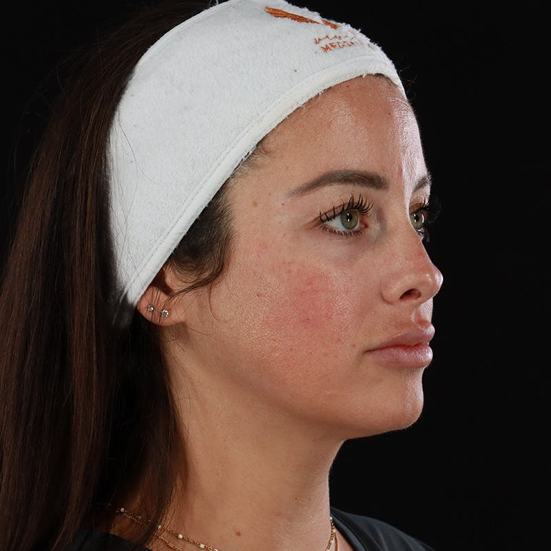 Dermal Fillers Before & After Gallery - Patient 131961 - Image 5