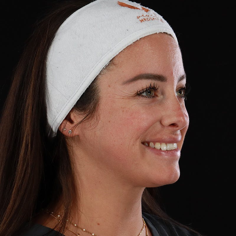 Dermal Fillers Before & After Gallery - Patient 131961 - Image 6