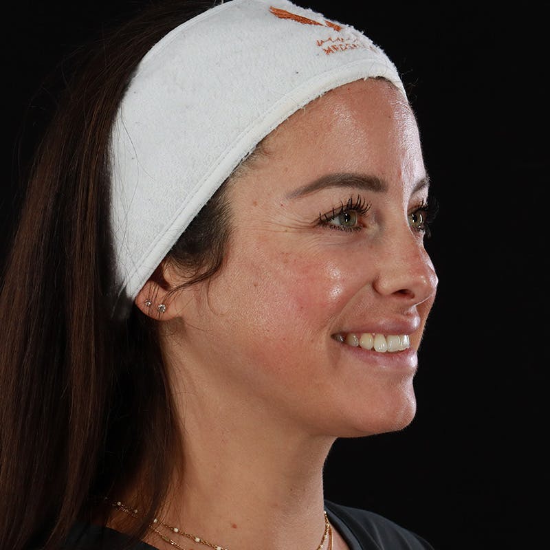 Dermal Fillers Before & After Gallery - Patient 131961 - Image 4