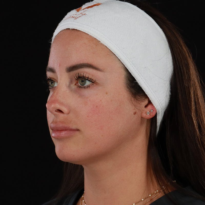 Dermal Fillers Before & After Gallery - Patient 131961 - Image 9