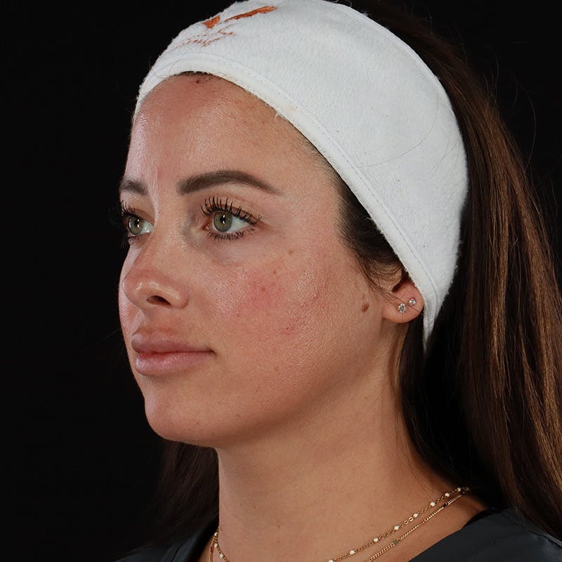 Dermal Fillers Before & After Gallery - Patient 131961 - Image 10