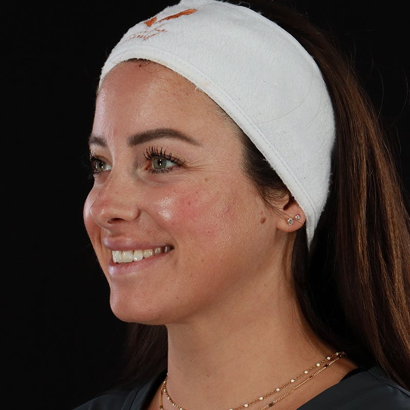 Dermal Fillers Before & After Gallery - Patient 131961 - Image 8