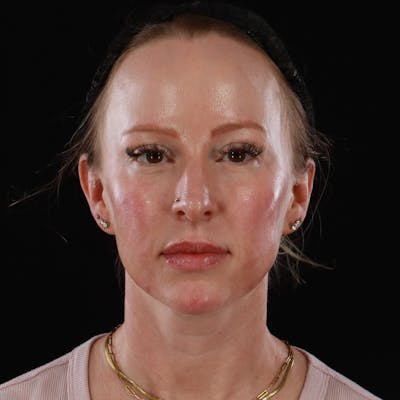 Dermal Fillers Before & After Gallery - Patient 208768 - Image 2