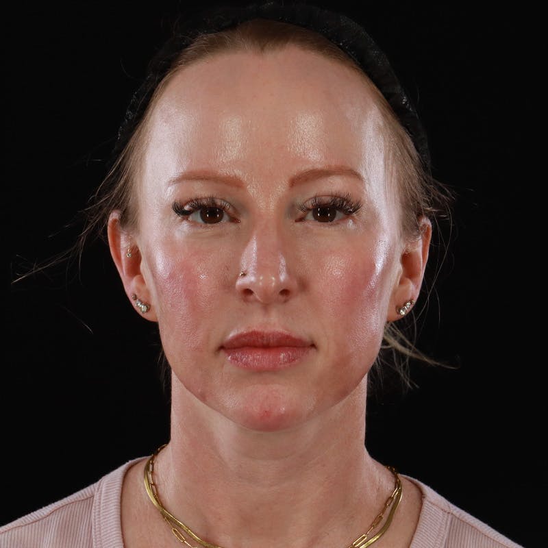 Dermal Fillers Before & After Gallery - Patient 208768 - Image 2