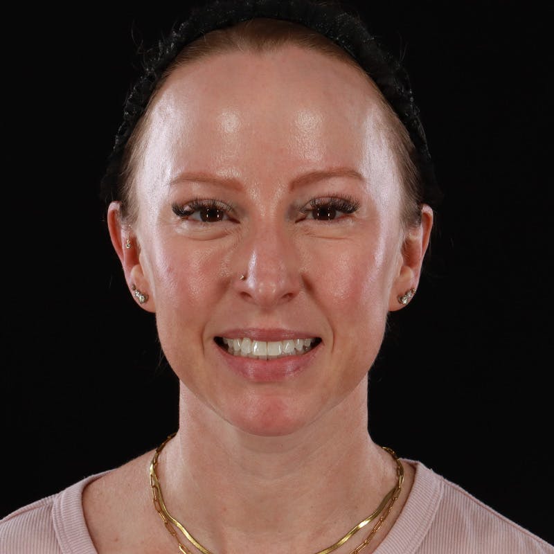 Dermal Fillers Before & After Gallery - Patient 208768 - Image 3