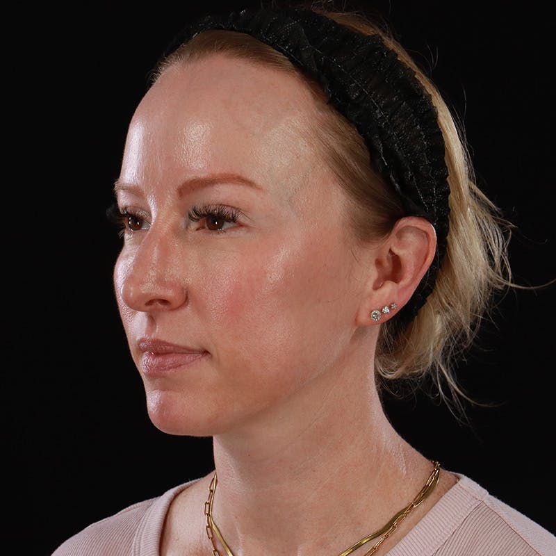 Dermal Fillers Before & After Gallery - Patient 208768 - Image 7