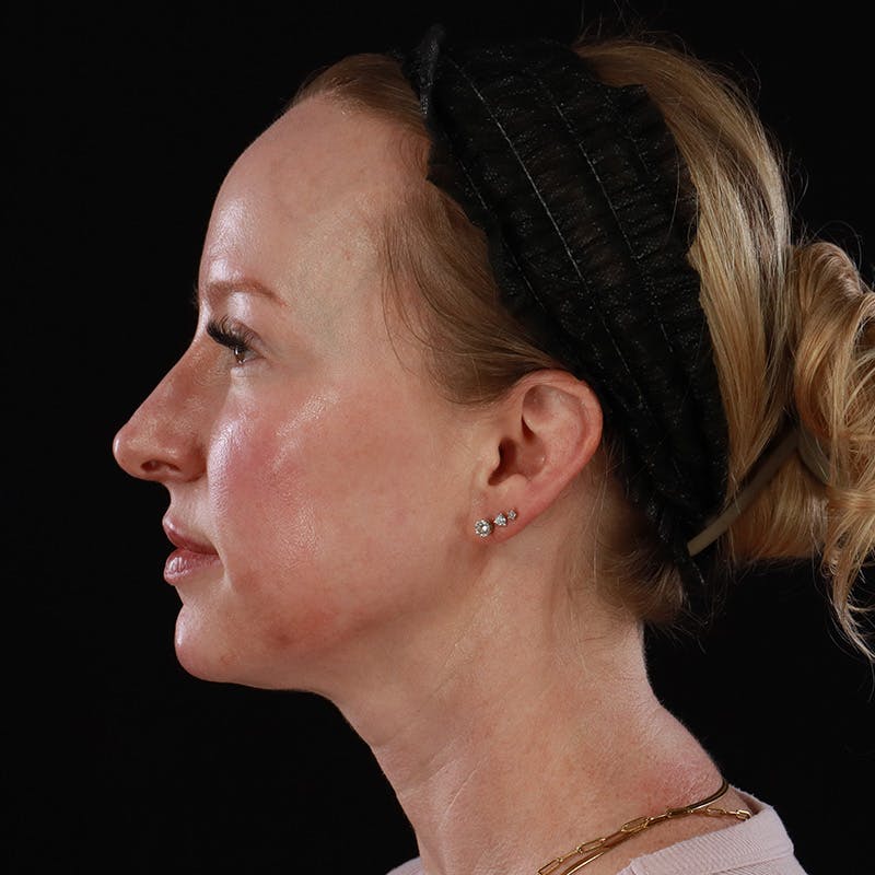 Dermal Fillers Before & After Gallery - Patient 208768 - Image 12