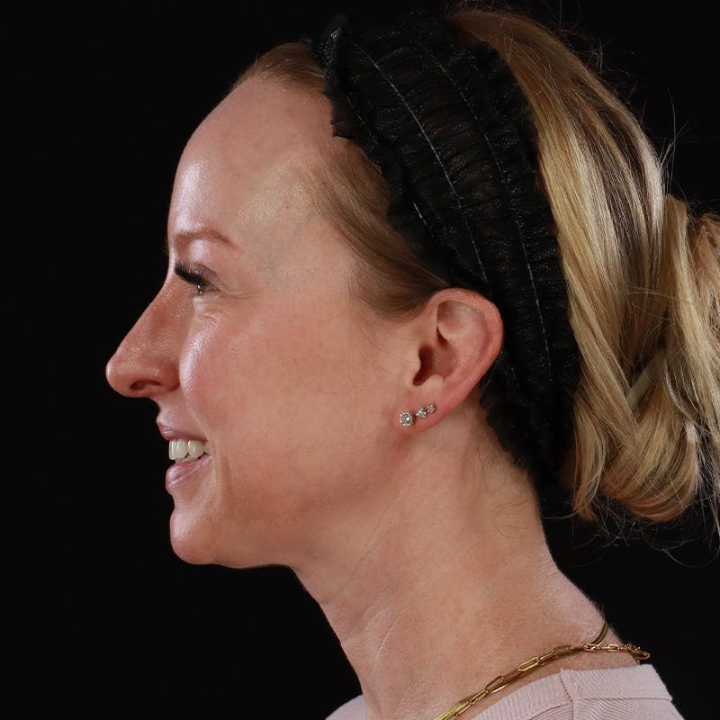 Dermal Fillers Before & After Gallery - Patient 208768 - Image 9