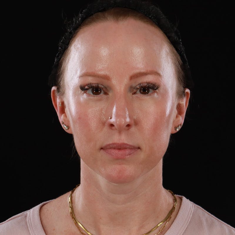 Dermal Fillers Before & After Gallery - Patient 208768 - Image 1