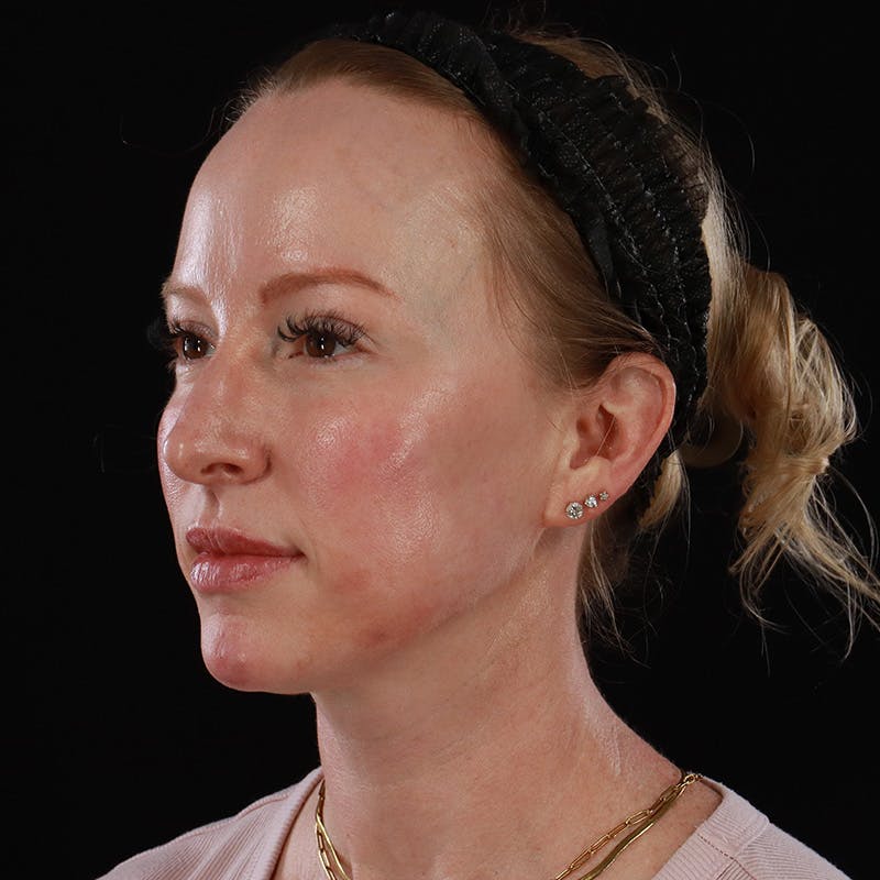 Dermal Fillers Before & After Gallery - Patient 208768 - Image 8