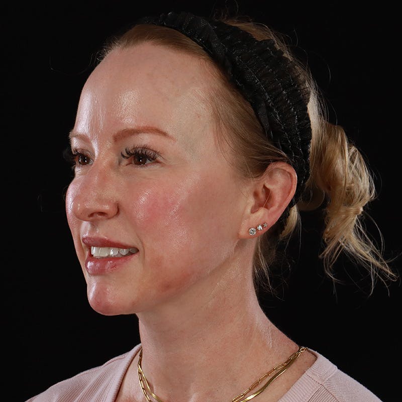 Dermal Fillers Before & After Gallery - Patient 208768 - Image 6