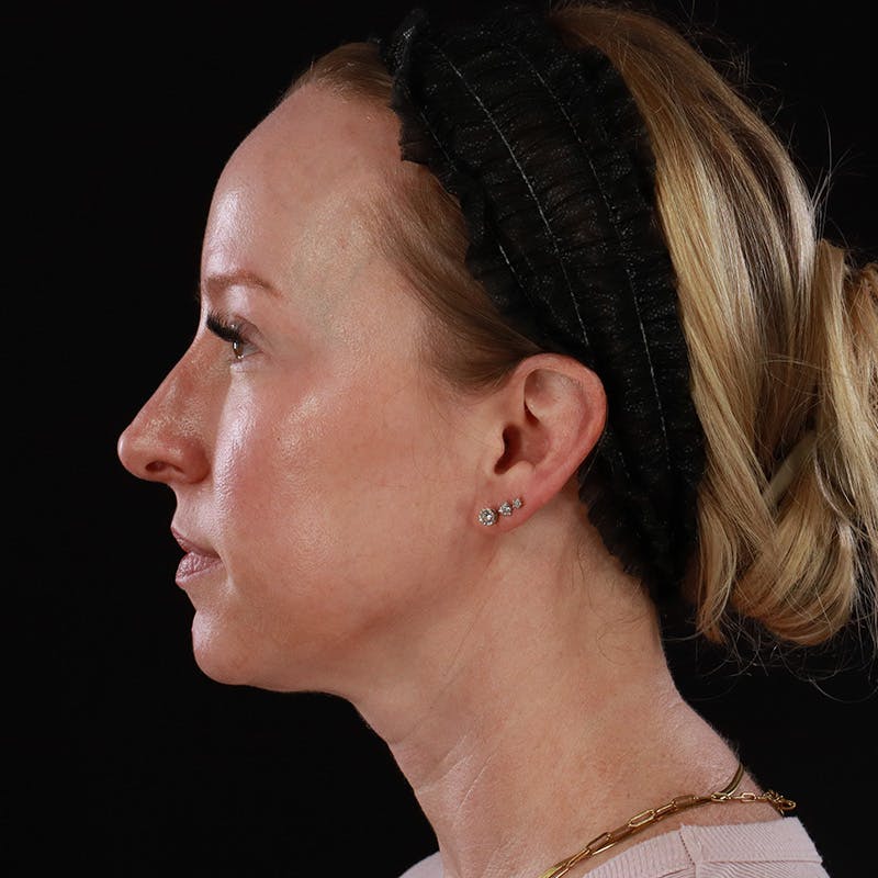 Dermal Fillers Before & After Gallery - Patient 208768 - Image 11
