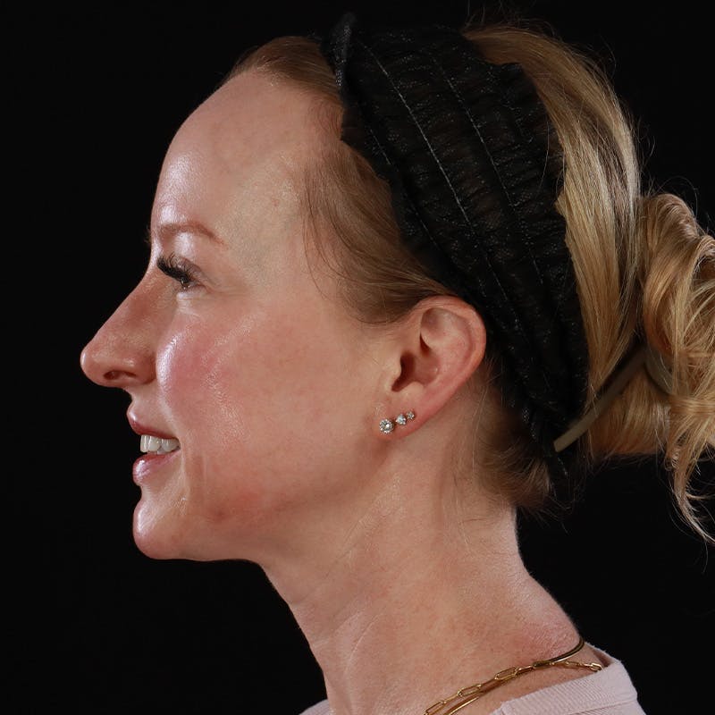 Dermal Fillers Before & After Gallery - Patient 208768 - Image 10