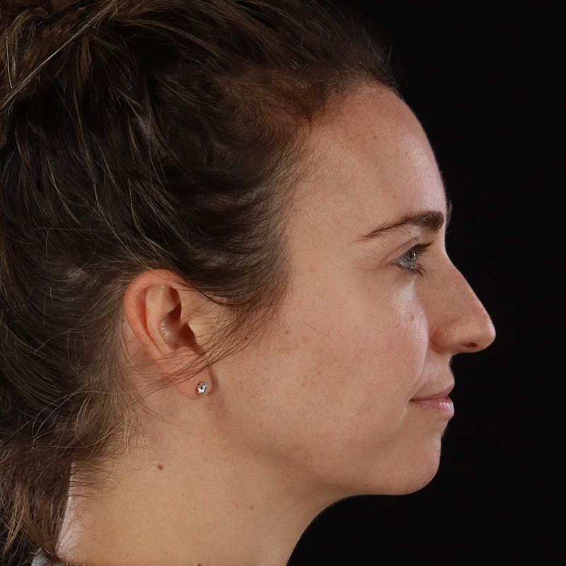 Dermal Fillers Before & After Gallery - Patient 118854 - Image 5