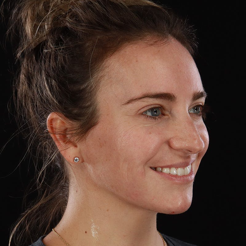 Dermal Fillers Before & After Gallery - Patient 118854 - Image 4
