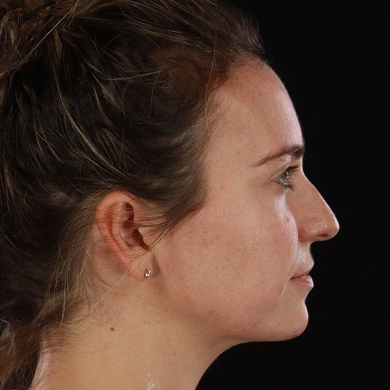 Dermal Fillers Before & After Gallery - Patient 118854 - Image 6