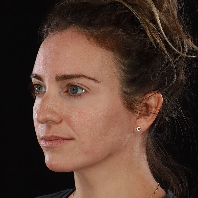 Dermal Fillers Before & After Gallery - Patient 118854 - Image 8