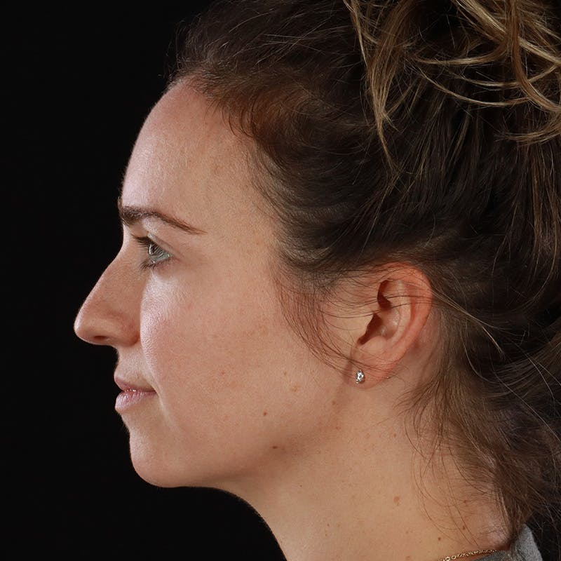 Dermal Fillers Before & After Gallery - Patient 118854 - Image 11