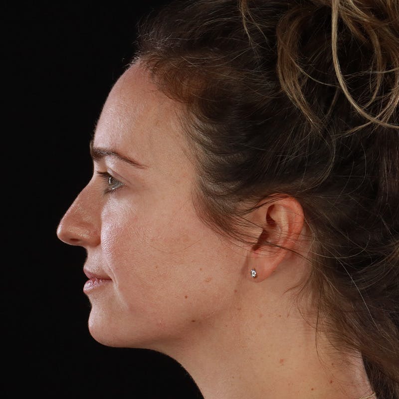 Dermal Fillers Before & After Gallery - Patient 118854 - Image 12