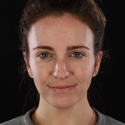 Dermal Fillers Before & After Gallery - Patient 118854 - Image 1