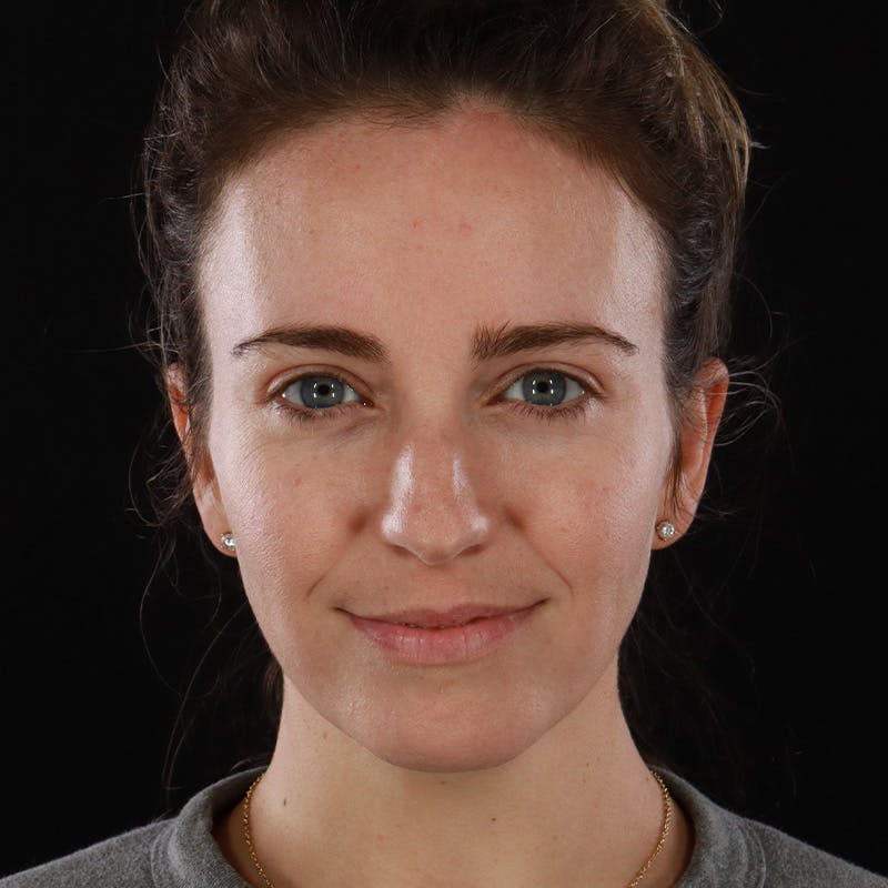 Dermal Fillers Before & After Gallery - Patient 118854 - Image 1
