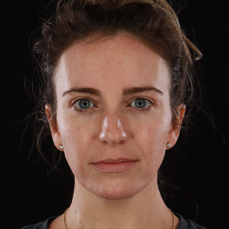 Dermal Fillers Before & After Gallery - Patient 118854 - Image 2