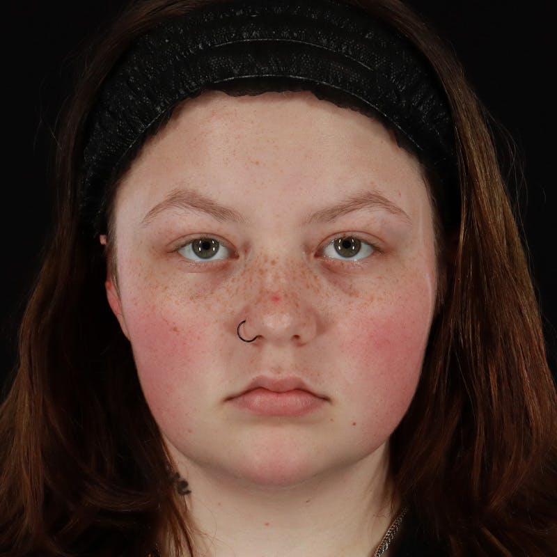 Dermal Fillers Before & After Gallery - Patient 394618 - Image 1