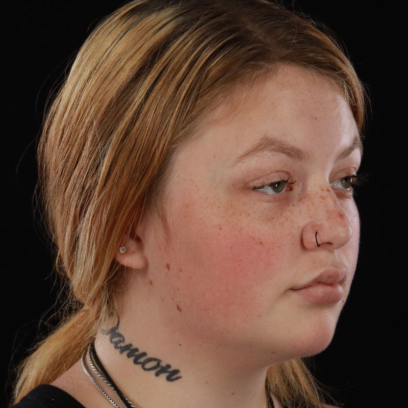 Dermal Fillers Before & After Gallery - Patient 394618 - Image 4