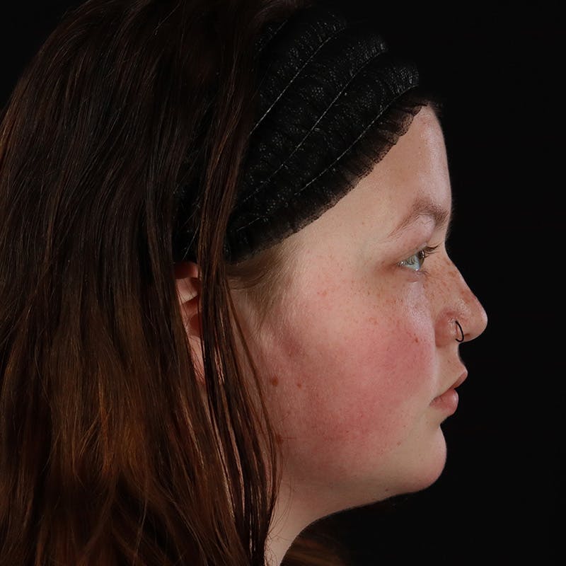 Dermal Fillers Before & After Gallery - Patient 394618 - Image 5