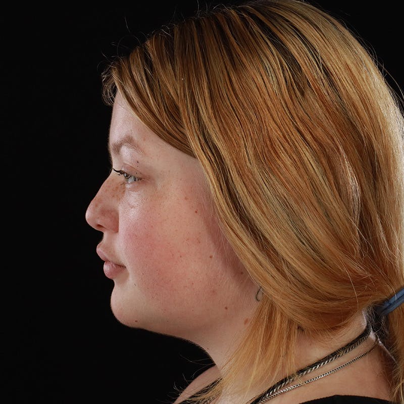 Dermal Fillers Before & After Gallery - Patient 394618 - Image 10