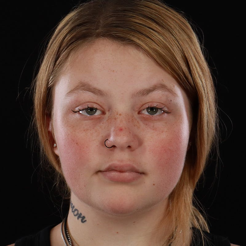Dermal Fillers Before & After Gallery - Patient 394618 - Image 2