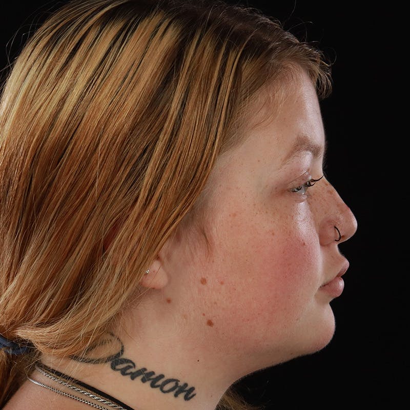 Dermal Fillers Before & After Gallery - Patient 394618 - Image 6