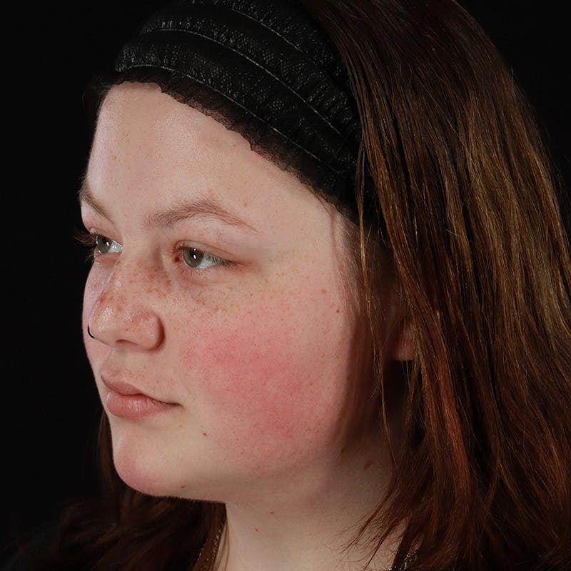 Dermal Fillers Before & After Gallery - Patient 394618 - Image 7