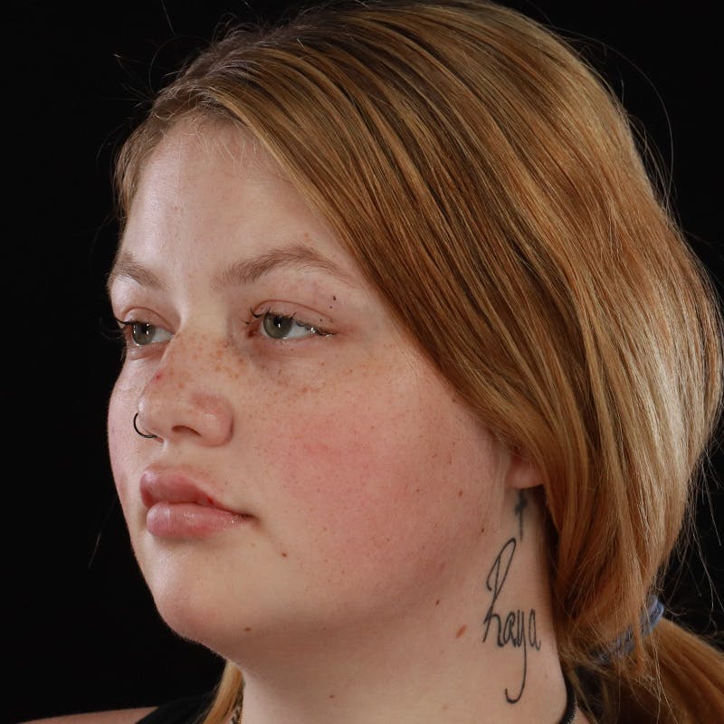Dermal Fillers Before & After Gallery - Patient 394618 - Image 8