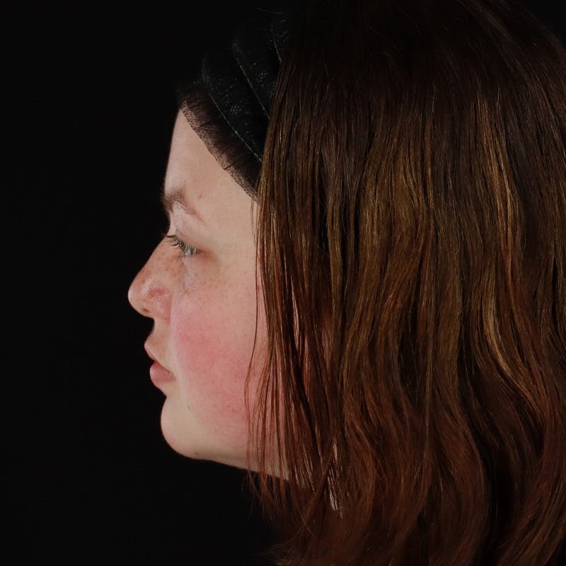 Dermal Fillers Before & After Gallery - Patient 394618 - Image 9