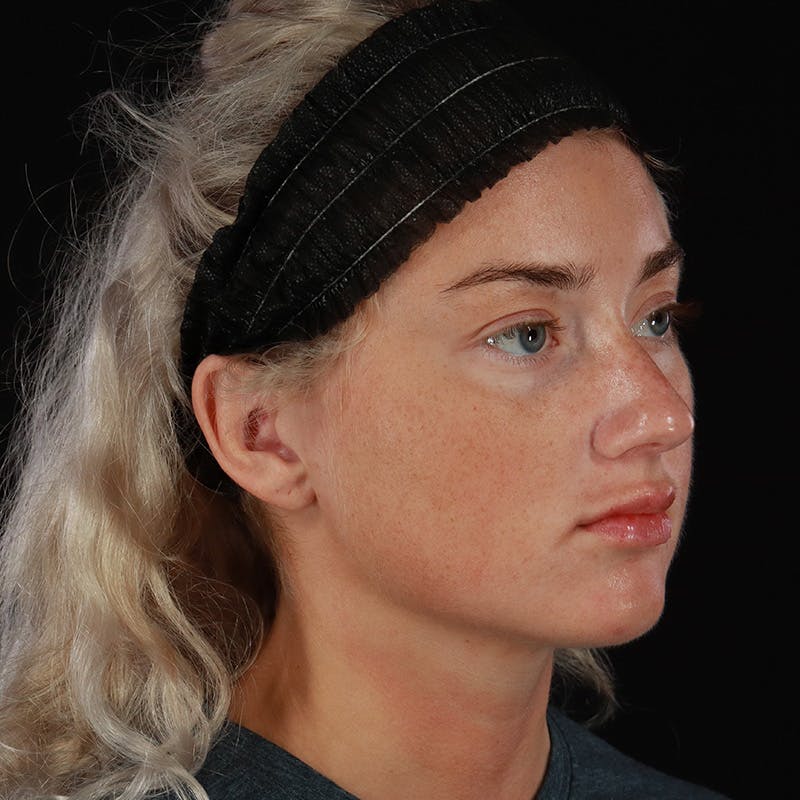 Dermal Fillers Before & After Gallery - Patient 280771 - Image 4