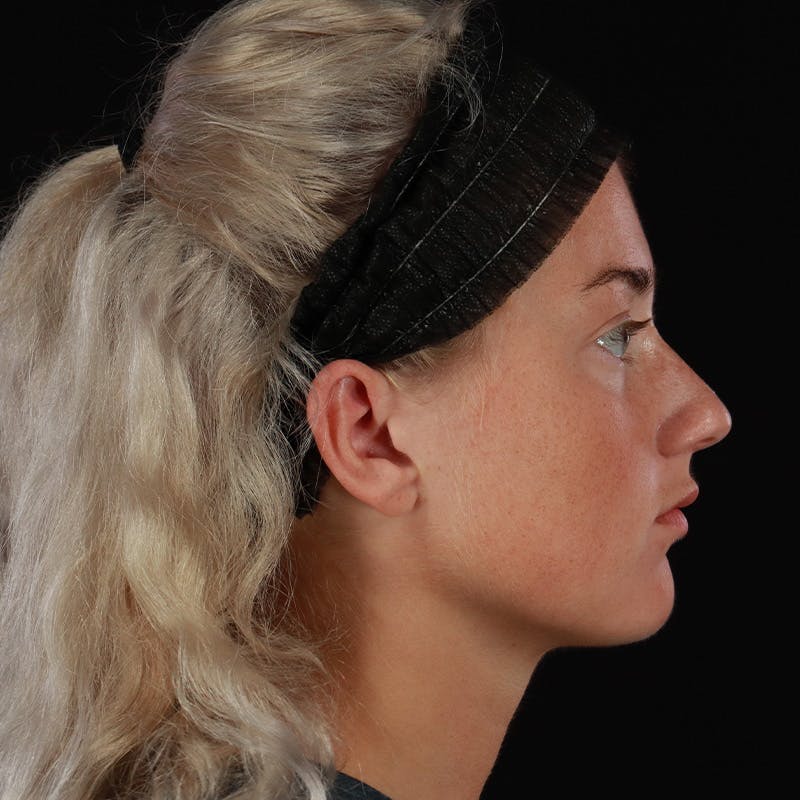 Dermal Fillers Before & After Gallery - Patient 280771 - Image 5