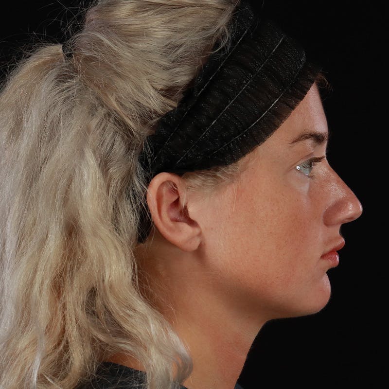 Dermal Fillers Before & After Gallery - Patient 280771 - Image 6
