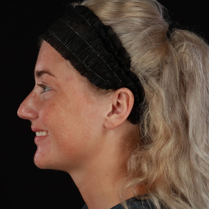 Dermal Fillers Before & After Gallery - Patient 280771 - Image 11