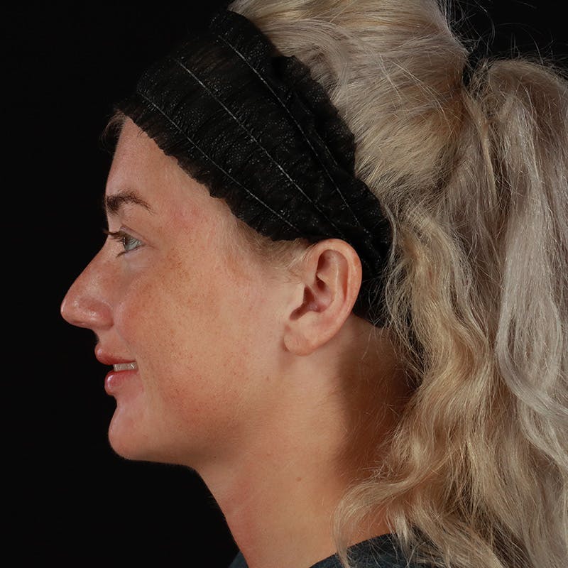 Dermal Fillers Before & After Gallery - Patient 280771 - Image 12