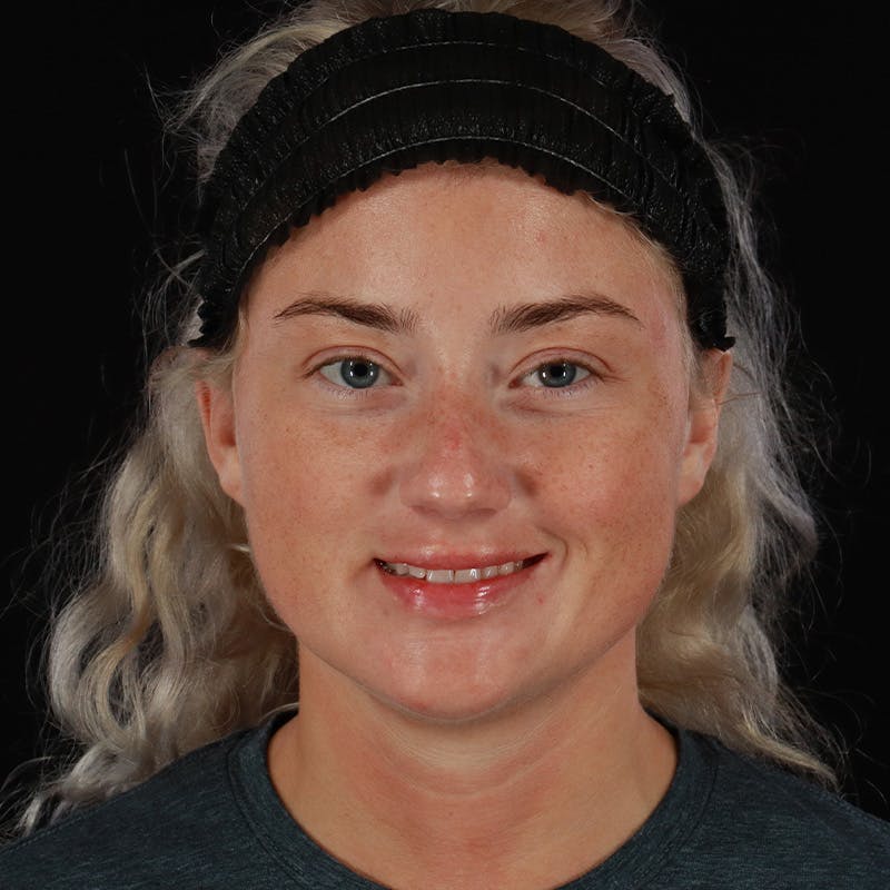 Dermal Fillers Before & After Gallery - Patient 280771 - Image 2