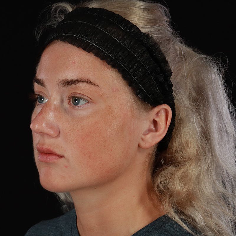 Dermal Fillers Before & After Gallery - Patient 280771 - Image 7