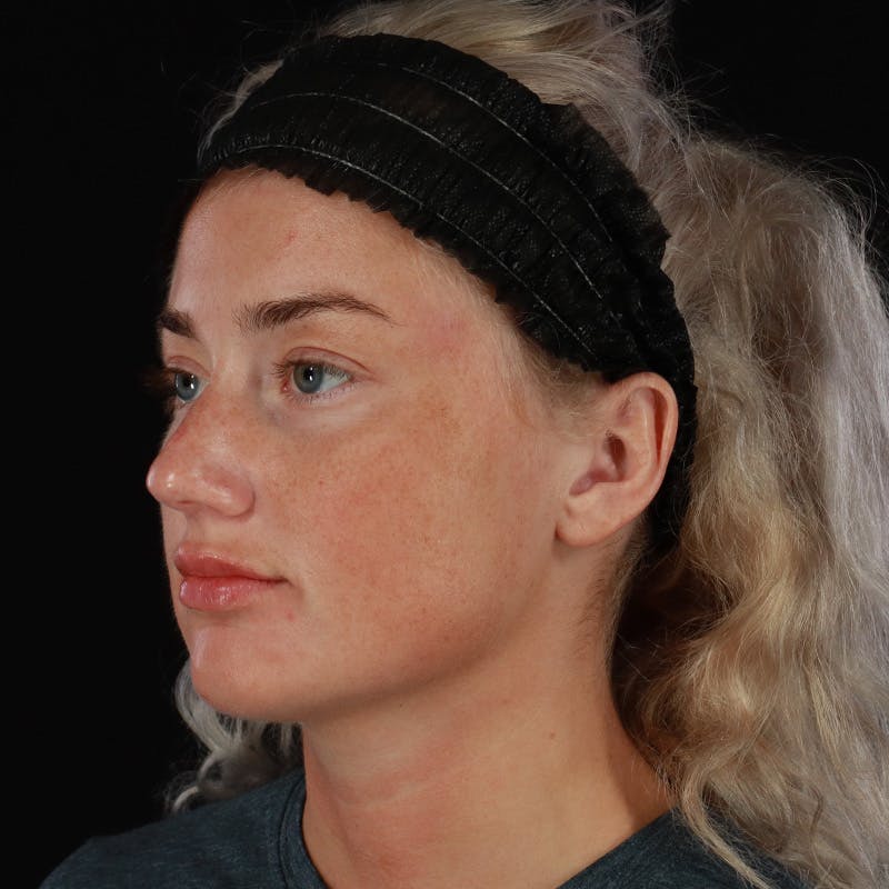 Dermal Fillers Before & After Gallery - Patient 280771 - Image 8