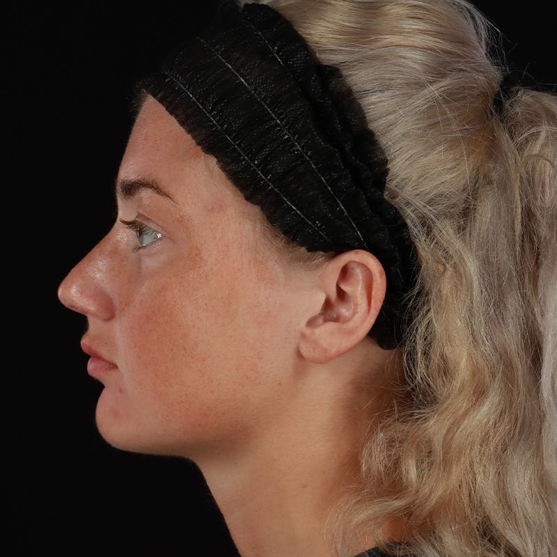 Dermal Fillers Before & After Gallery - Patient 280771 - Image 9