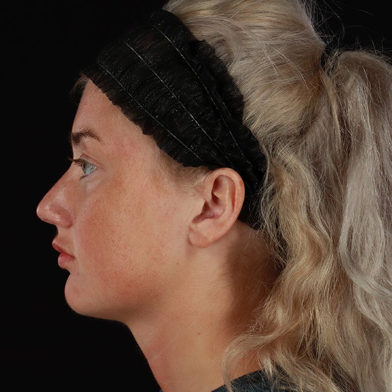Dermal Fillers Before & After Gallery - Patient 280771 - Image 10