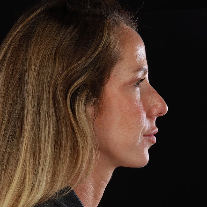 Dermal Fillers Before & After Gallery - Patient 189502 - Image 5