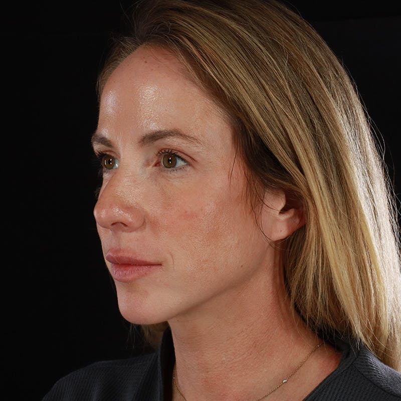 Dermal Fillers Before & After Gallery - Patient 189502 - Image 7