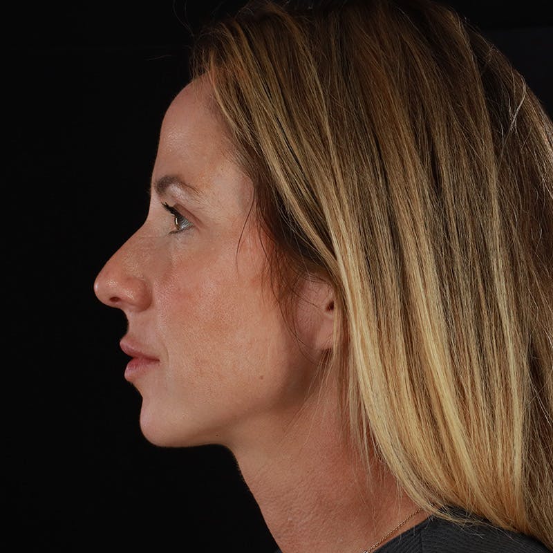 Dermal Fillers Before & After Gallery - Patient 189502 - Image 9