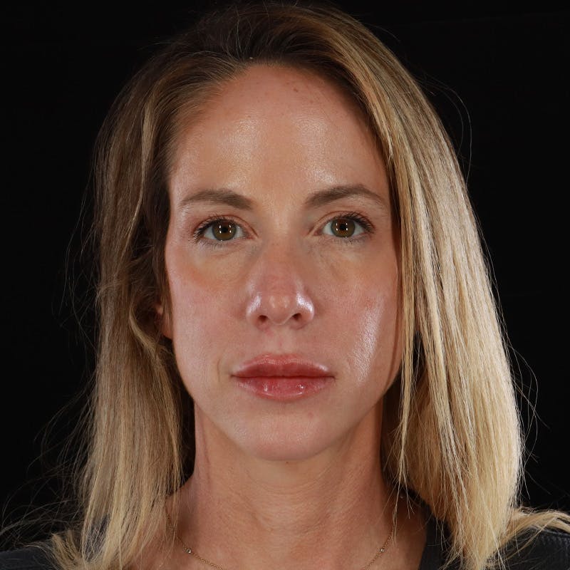 Dermal Fillers Before & After Gallery - Patient 189502 - Image 2