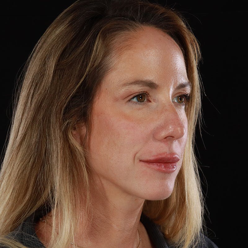 Dermal Fillers Before & After Gallery - Patient 189502 - Image 4